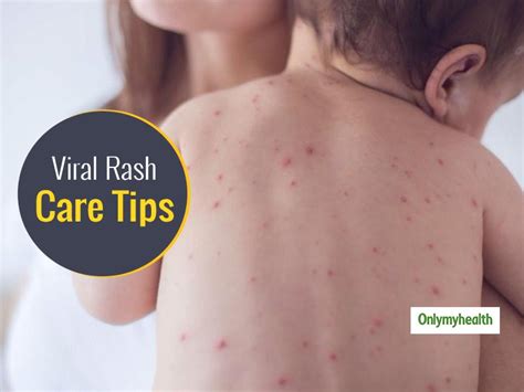 Tips To Identify and Diagnose A Viral Rash in Infants | OnlyMyHealth