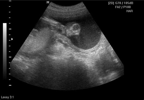 Anencephaly Ultrasound