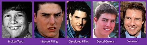 Tom Cruise Teeth Before After / Tom Cruise Before Braces R Pics - Machiko Kanegi