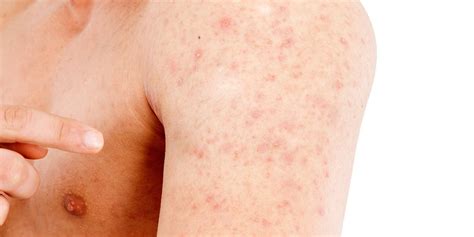 Heat Rash Treatment | Men’s Health