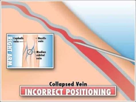 Collapsed vein - YouTube