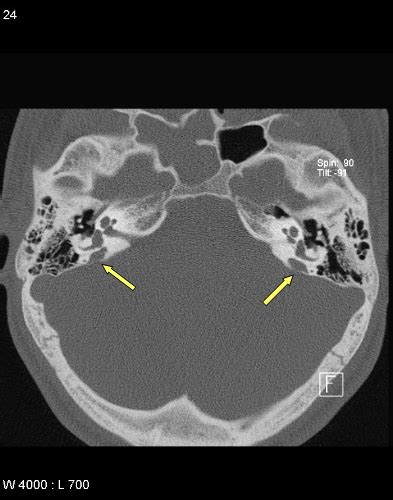 Enlarged vestibular aqueduct syndrome | Eurorad