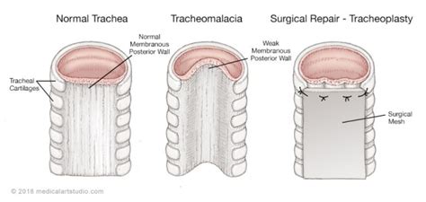 Tracheomalacia Tracheostomy