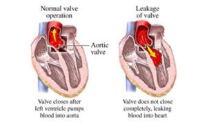 Heart valve leakage problems and proper treatments for beginner