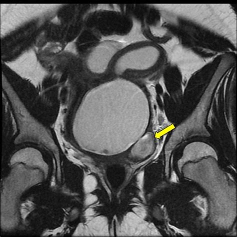 MRI of the pelvis (a) Axial T2WI demonstrating uterus didelphys with... | Download Scientific ...