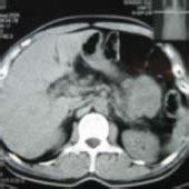 b: CT scan of abdomen showing distal pancreatic mass | Download Scientific Diagram