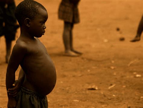 Panorama de la malnutrition dans le monde - Major-Prépa