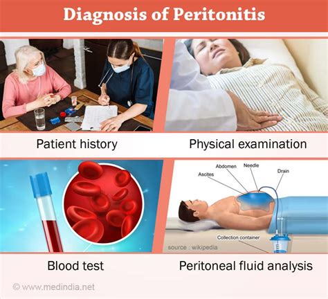 Peritonitis - Causes, Symptoms, Complications, Diagnosis, Treatment ...