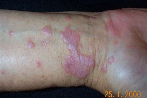 Skin Plaque Appearance, Causes, and Diagnosis