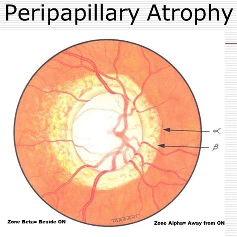 GLAUCOMA SPECIALIST BLOG: "THE GLOG"