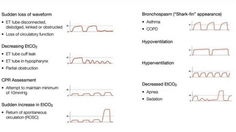 Wave form capnography | Emergency medicine, Icu nursing, Respiratory care