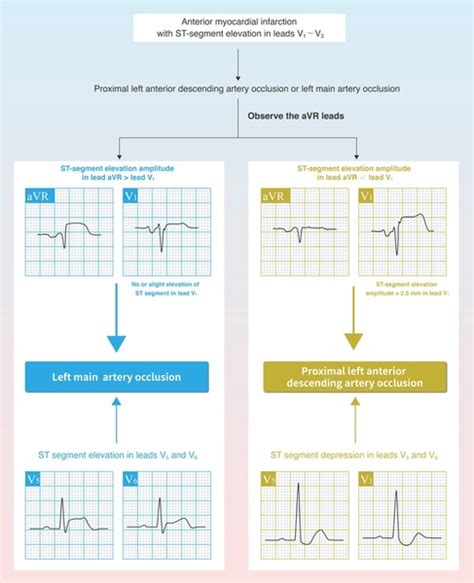 403 Acute Coronary Syndrome Ecg Images, Stock Photos, 3D objects, & Vectors | Shutterstock