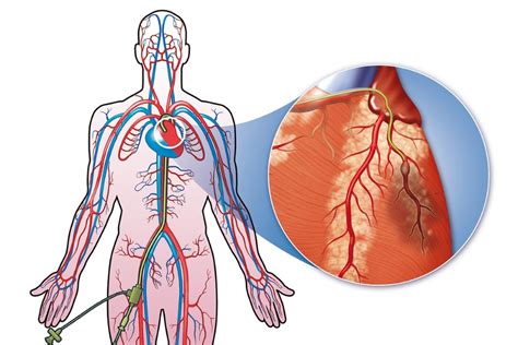 Cardiac Catheterization - What Is Cardiac Catheterization | NHLBI, NIH