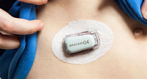 Automatic Insulin Dosing - Intelligent Algorithms for better Glucose ...