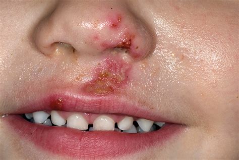 Facial ulcers in children | GPonline