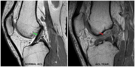 Mri Knee Acl Tear