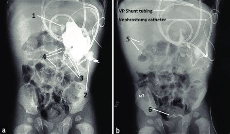 Radiological images of antegrade pyelography done on post-operative day... | Download Scientific ...