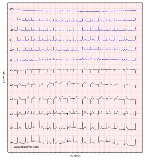 Atrial fibrillation: ECG, classification, causes, risk factors ...