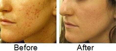 How To Get Rid Of Back Acne In A Week Naturally at Jeremy Ramey blog