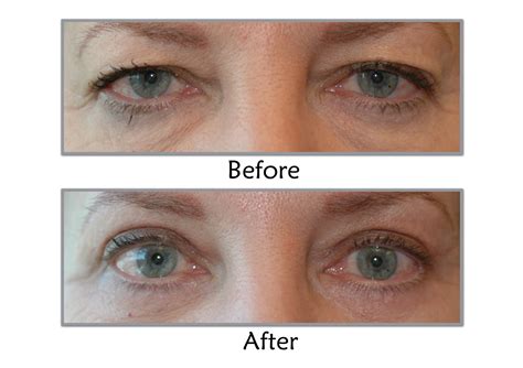 Eyelid Lift Salt Lake City, Utah | Blepharoplasty