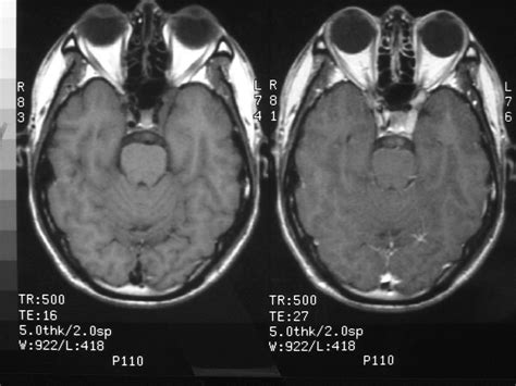 Cavernous Sinus Mri