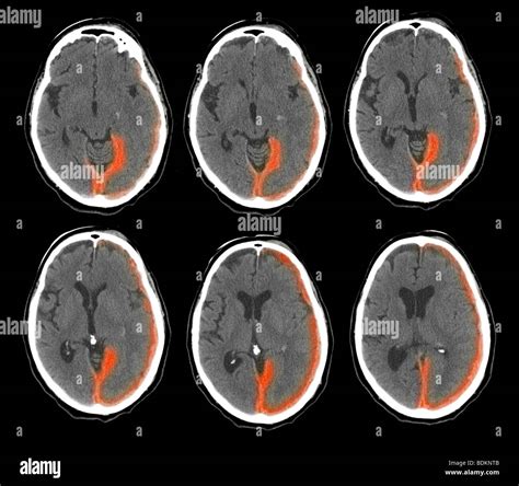 CT scan of the brain of a 73 year old man show intracranial bleeding Stock Photo - Alamy