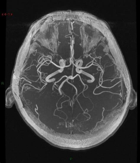 Mri angiography, brain Mri, Muscle Pain, Brain Health, X Ray, Organs, Body Works, Random Items ...