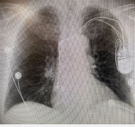 Chest radiograph demonstrating normal cardiomediastinal contours ...