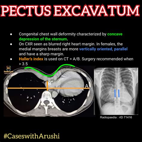 Pectus Excavatum