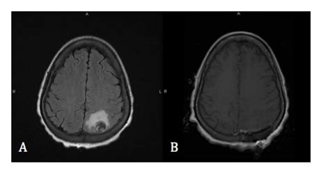 Brain Stem Tumor Mri