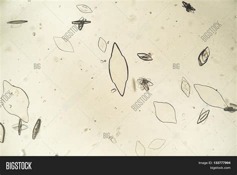 Uric Acid Crystals Image & Photo (Free Trial) | Bigstock