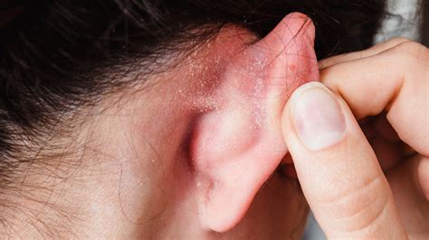 Why You Get Dry Skin Behind Your Ears And How To Treat It