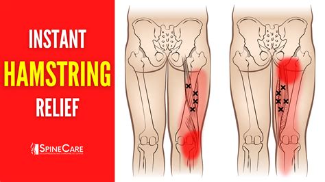 How to Fix Hamstring Pain FOR GOOD | SpineCare