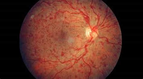 Retinal Vein Occlusion: Symptoms, Treatment and Prevention