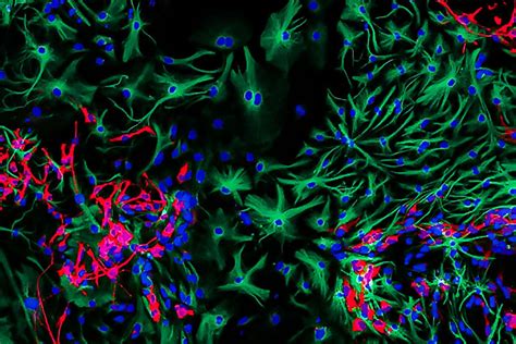 Close-up image of brain cancer cells wins photography prize | New Scientist