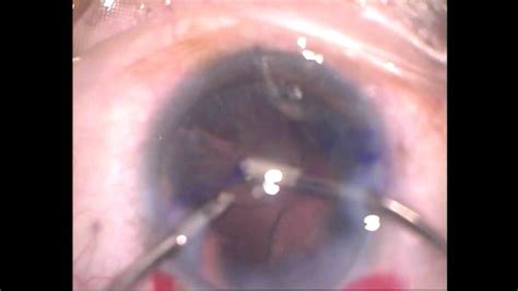 Cataract Surgery and Toric Intraocular Lens Implantation By Dr.Uday Gadgil - YouTube