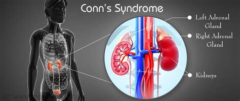 Conn s Syndrome | Primary Hyperaldosteronism - Causes. Symptoms, Diagnosis, Treatment ...