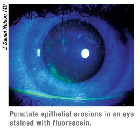 The Pros and Cons of Dry-Eye Tests