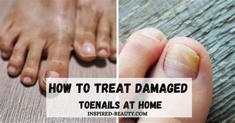 How to Treat Damaged Toenails at Home - Inspired Beauty