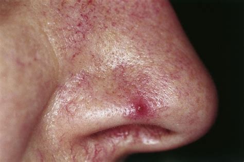 Bleeding Pore on Nose [11 Possible Causes and Treatments] - Skin Care Geeks