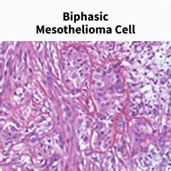 The 4 Types of Mesothelioma: Pleural, Peritoneal & Cell Types