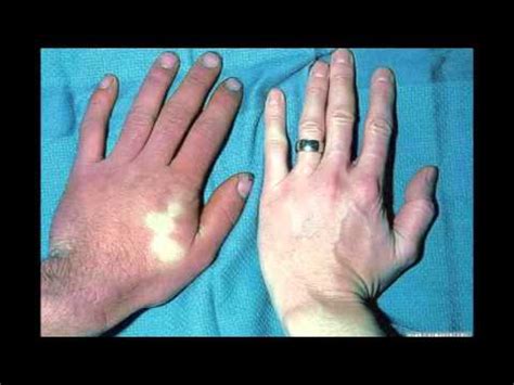 Acrocyanosis - YouTube