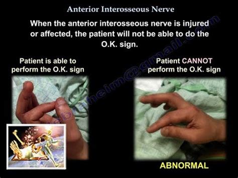 Anterior Interosseous Nerve Syndrome