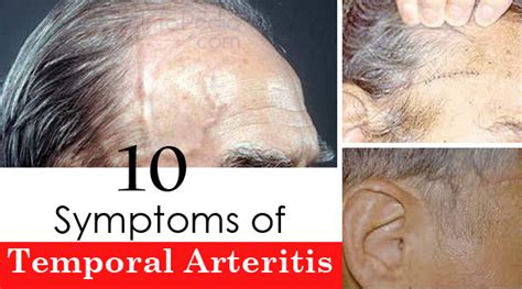 10 Symptoms of Temporal Arteritis - Getinfopedia.com