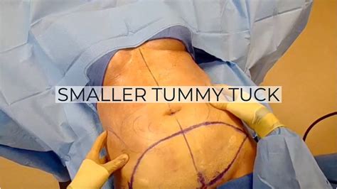 Full tummy tuck belly button - tasteconstruction