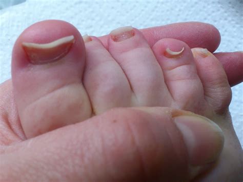 melanoma on toes - pictures, photos