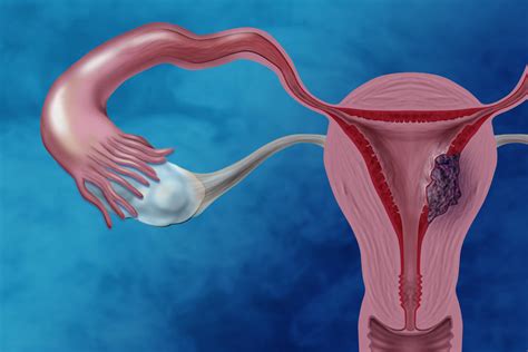 CIENCIASMEDICASNEWS: Treating Endometrial Cancer without Radiation - National Cancer Institute