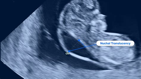 Nuchal Translucency Ultrasound (NT Scan): Test Results and More