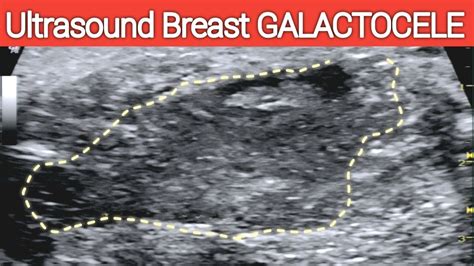 Ultrasound BREAST GALACTOCELE - A Lactating Breast - Complicated Milk Cyst - YouTube