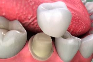 How is Your Tooth Prepared for a Dental Crown?